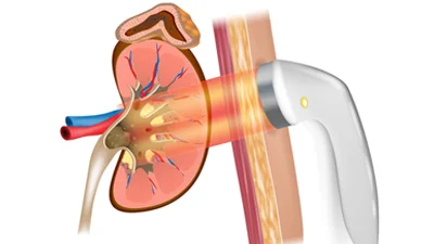 Lithotripsy