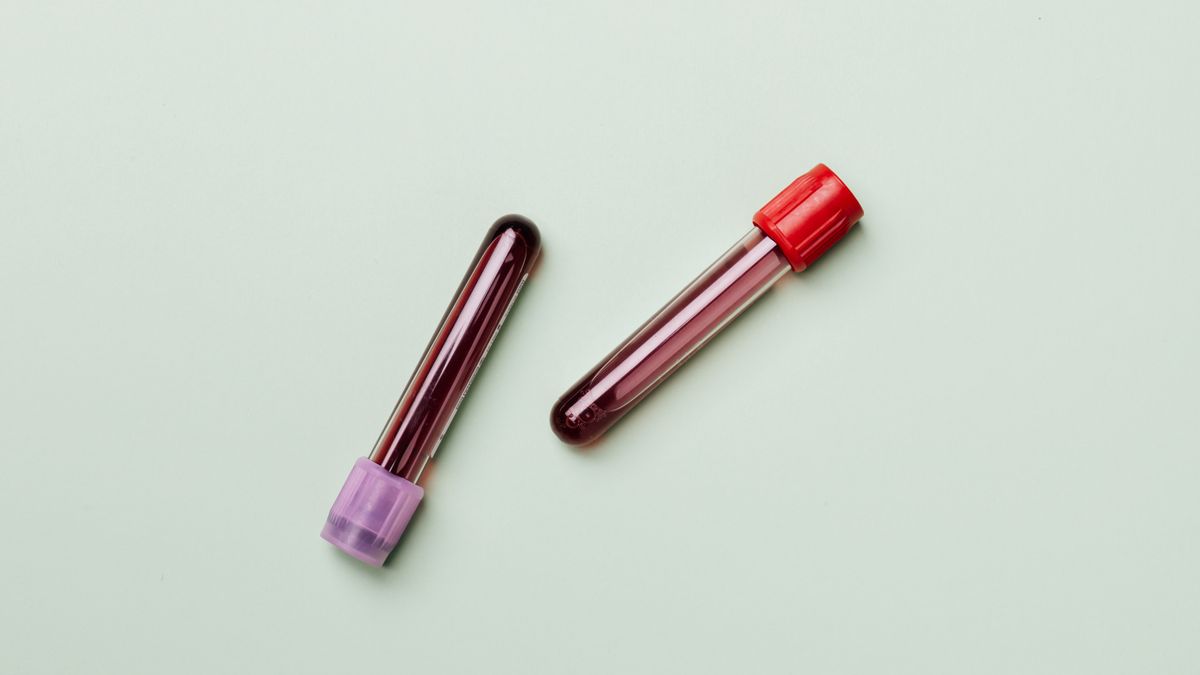 Blood sample tubes used to check iron, vitamin D, B12 and thyroid levels in hair loss